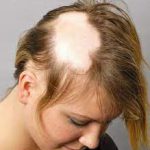 آلوپسی یا ریزش مو در خانم ها و آقایان + روش های درمان
